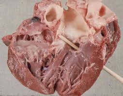 A picture of a calf heart with VSD. The stick is going through the hole in the wall between the chambers.